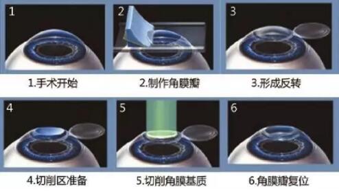近视准分子激光手术.jpg