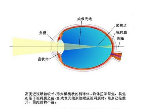 高度近视眼.jpg