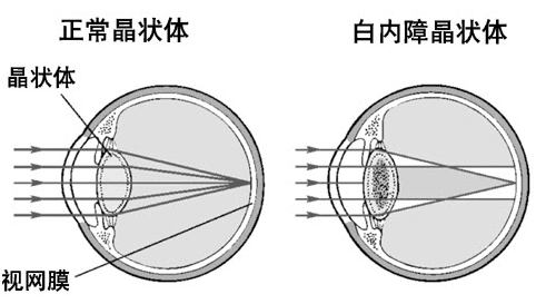 白内障的原因.png