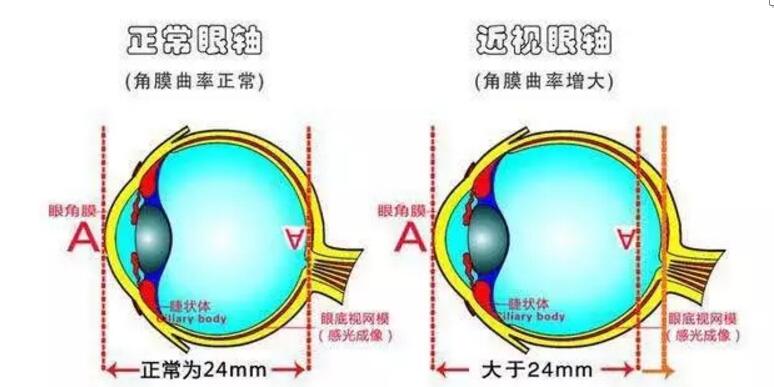 正常眼轴近视眼轴.jpg